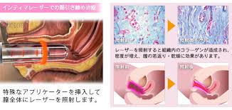 その症状、萎縮性膣炎かもしれません